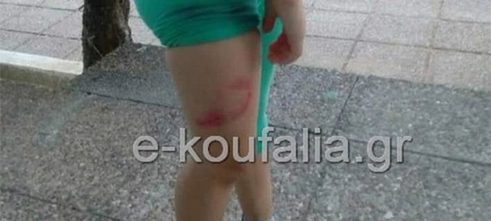 7χρονη δέχτηκε επίθεση από τρία αδέσποτα σκυλιά στην Θεσσαλονίκη -Σοκαριστικές εικόνες